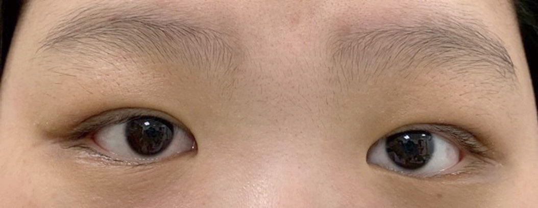依照病人要求縫製自然小摺痕的雙眼皮下眼瞼贅皮割除後無疤痕不僅改善睫毛倒插眼型也變得更美麗